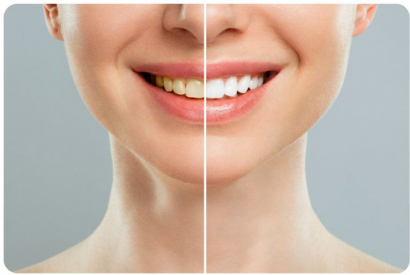 La cigarette électronique jaunit-elle les dents ?